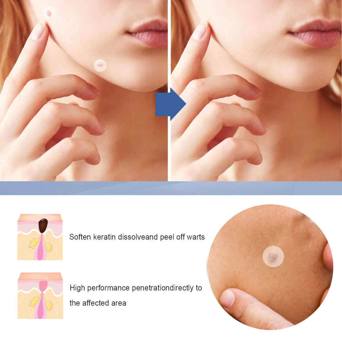 Wart Close To Skin Mole Black Mole Cleaning Care Skin Label Remover Patch