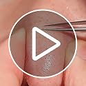 3 Pieces Removal Blackhead Tweezers Precision,Stainless Steel Extractor Acne Removal Kit Pimple Popper Tool, Clip for Whit...
