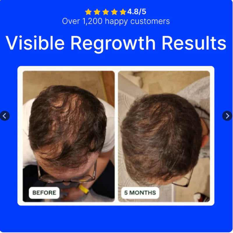 Hair Growth Microneedle Solution For Hair Regeneration
