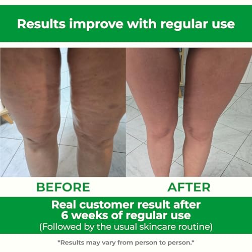 TESMED Cellulite Manual Massager : Made in Italy, Patented with Converging & Diverging Roller Technology. Anti Cellulite R...