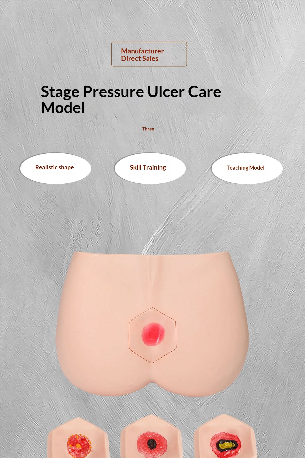 Stage Pressure Ulcer Care Model